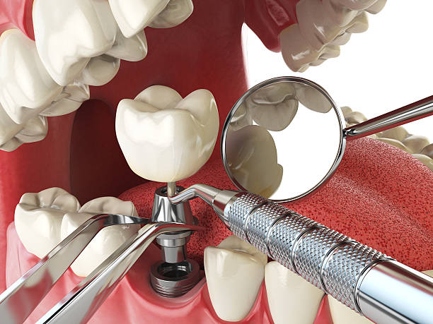 Best Dental Abscess Treatment in Upper Arlington, OH